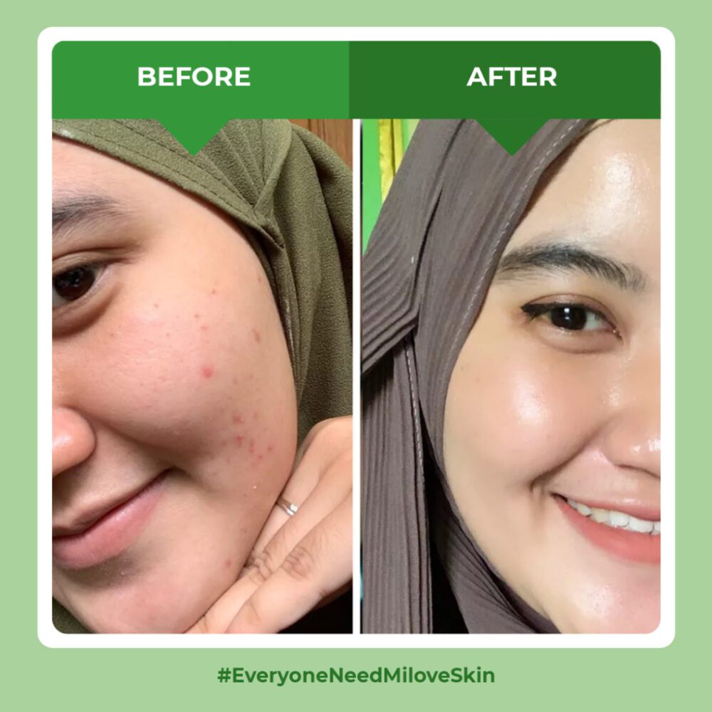 Milove Skin - Mi Versus Acne (Masker Wajah Organik Solusi Jerawat, Glowing, Bopeng, dsb) - Gambar 5